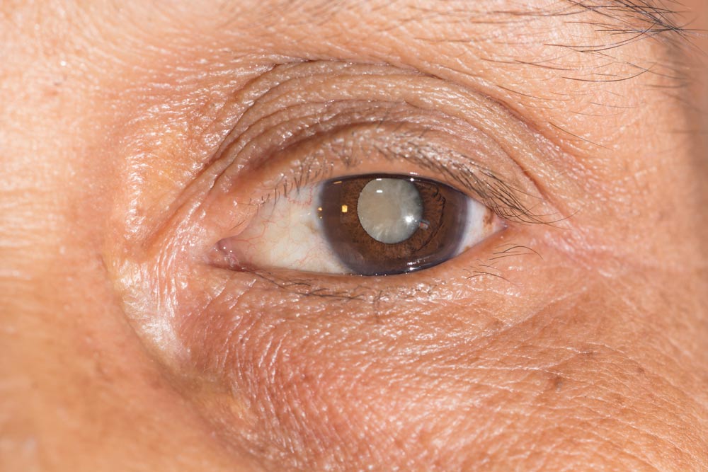 Cataract Consultation